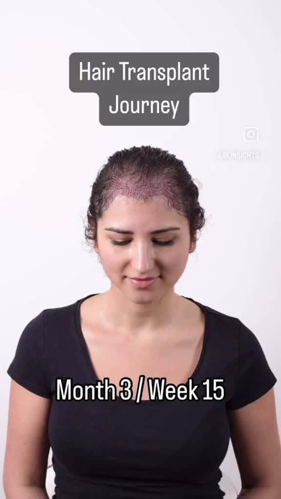 Cover for Week 15 hairtransplant hairtransplantation femalehairtransplant femalehairloss wo 23264 #shortvideosscoopz