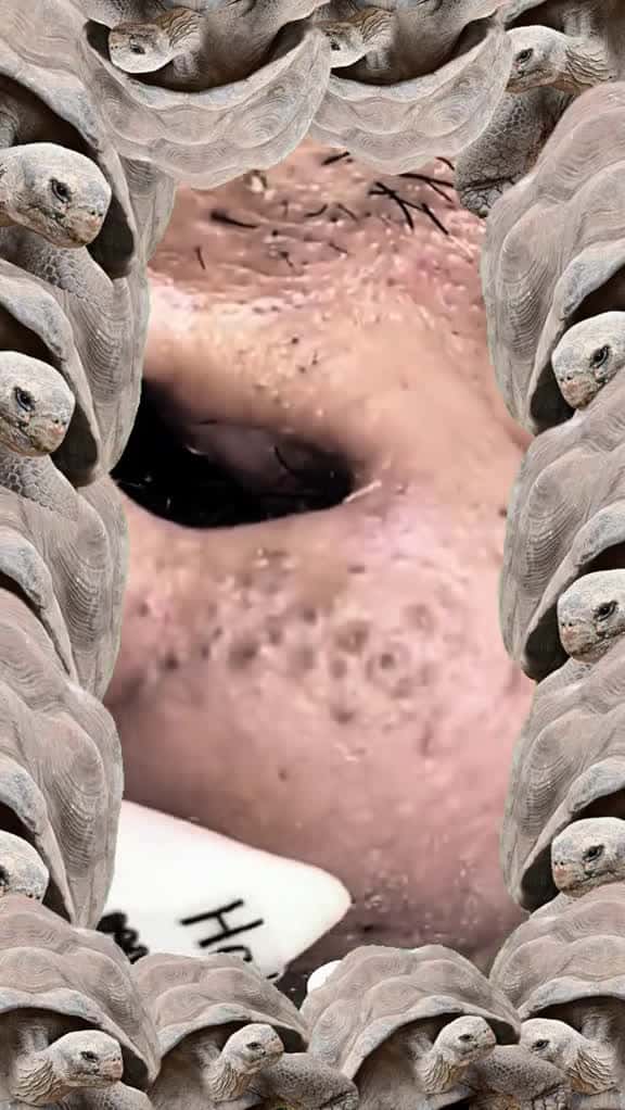 Cover for acne pimple relax satisfying foryou fyp 54846 #shortvideos