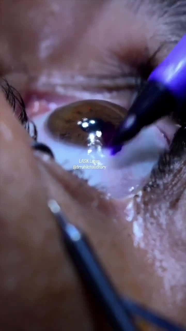 Cover for Watch the intricate precision of LASIK surgery up close! 👁 #LASIK #SurgerySatisfaction #MedicalMarvel