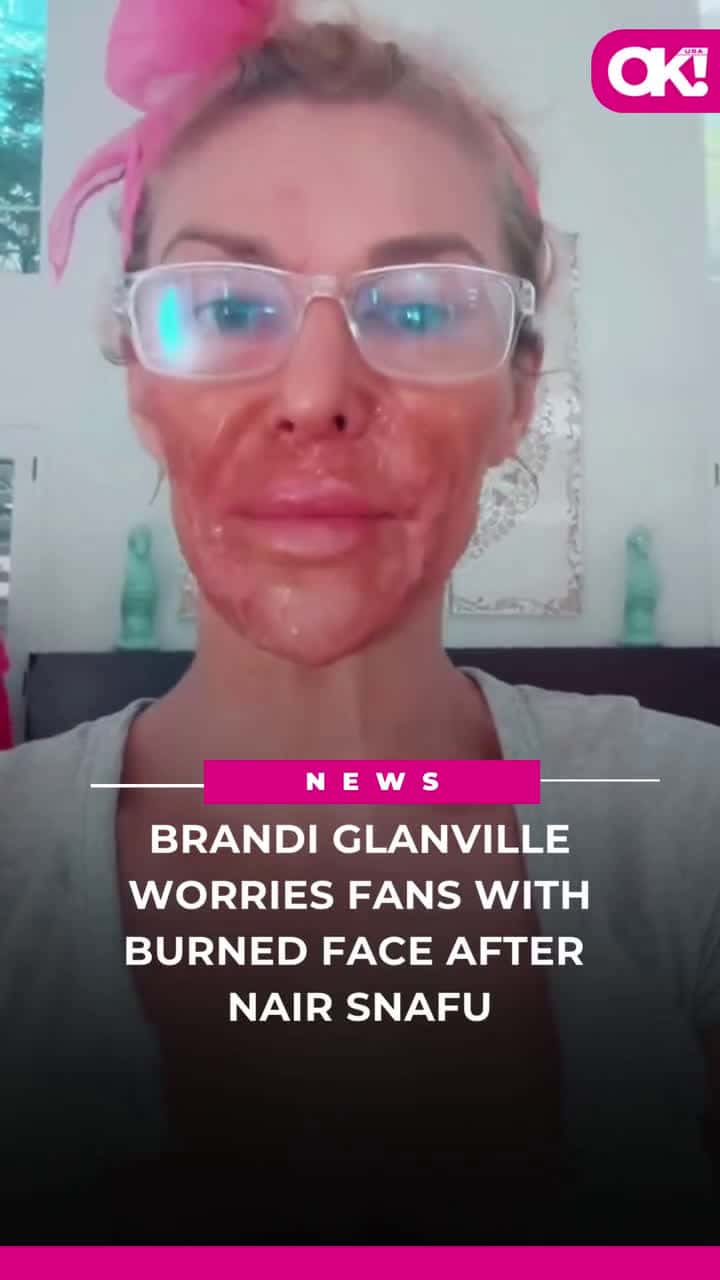 Cover for Brandi Glanville burned her face using Nair as she attempted to kill her facial parasite she’s been battling for two years.“I know I look attractive,” Glanville, 52, said in a graphic video she shared to her TikTok which showe...