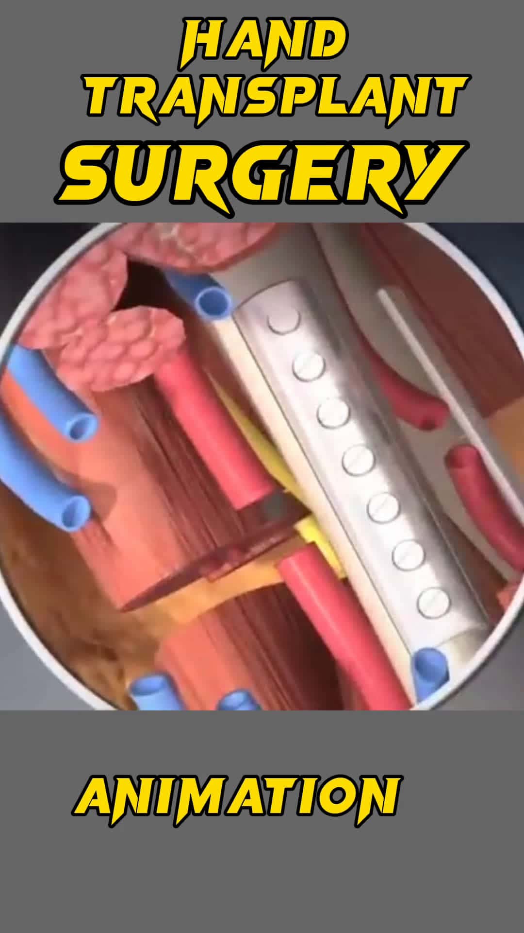 Cover for Hand Transplant Surgery 3D Animation #handtransplant #handsurgery #handtransplantsurgery #handtransplantation #handtransplantworkout #handgraft #medicalprocedure #medical3danimation #3dmedicalanimation #thanksgiving  #happytahnksgiving #family