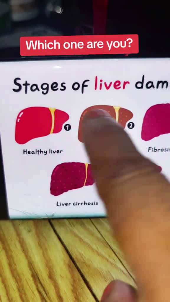 Cover for You only get one liver literally JUST ONE! @OXYENERGY.US #liverhealth ##liverdamage #resultsmayvary #wellness #detox  created by krystalkanarii with krystalkanarii’s original sound