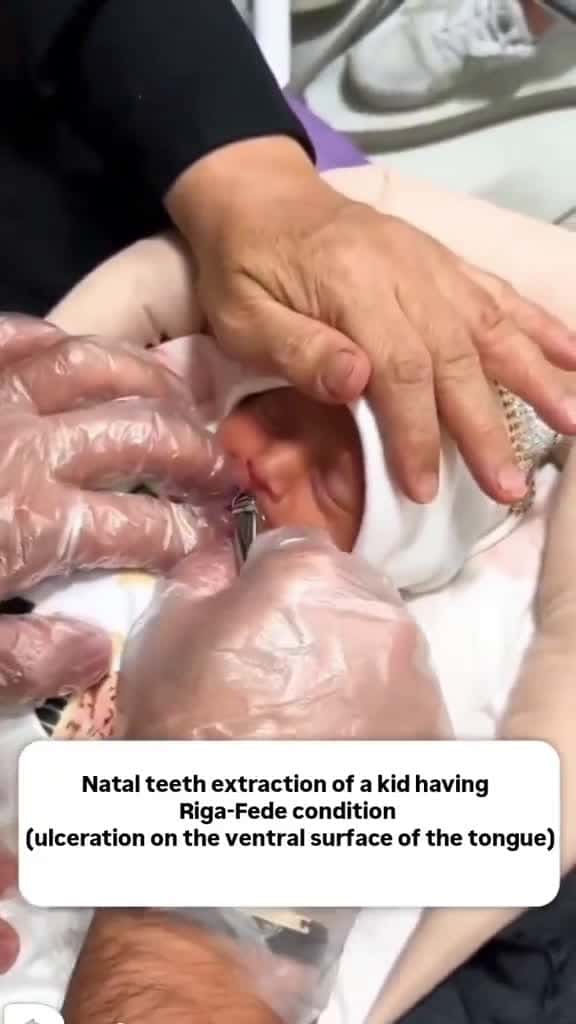 Cover for Natal Tooth Extraction 😳👀 Why should we extract Natal teeth? • •  • 📽By@zahrabaghdar75  --------------------------------------- #dentistry #dental #dentist #dentists #dentalstudent #dentalhygienist #dentalart #doctor #doctors #...