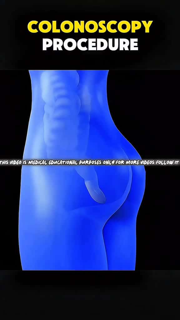 Cover for Colonoscopy Procedure (3D Animation) #colonoscopy #colonoscopyprep #colonoscopyday #coloncancer #coloncancerawareness #colonpolyp #colonpolypectomy #colonpolyps #medical3danimation #3dmedicalanimation created by 𝑰𝒎𝒎𝒆𝒓𝒔𝒊𝒗𝒆 𝑫𝒆𝒄𝒐𝒎...