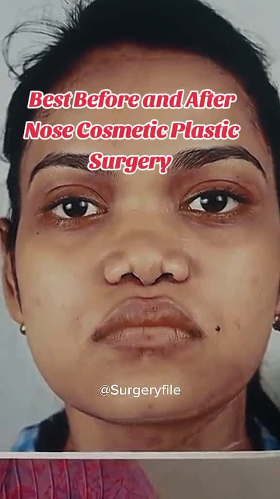 Cover for Best Before and After Nose Cosmetic Plastic Surgery surgeryonline surgeryfile ukhospital u 40448 #american