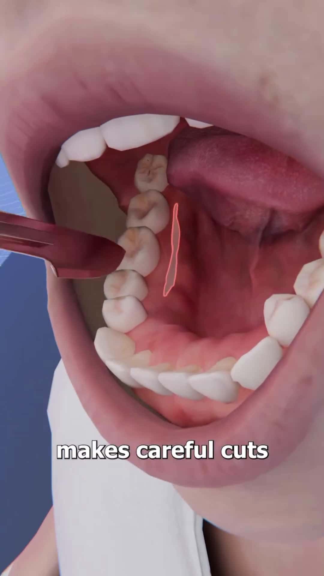 Cover for Mouth 😥 #fyppppppppppppppppppppppp #viral  #fyppppppppppppppppppppppp  #growmyaccount  #followme 