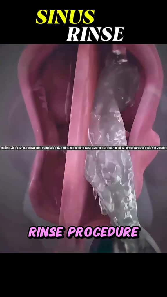Cover for Sinus Rinse Procedure 3D Animation #sinus #rinse #healthawareness #medical #science #sinisrinse #nasalrinse #nasalsalineflush #nasalsalineirrigation #nasalsaline #nosecleaning #noseclean #animation  created by 𝑰𝒎𝒎𝒆𝒓𝒔𝒊𝒗𝒆 𝑫𝒆𝒄𝒐𝒎 w...