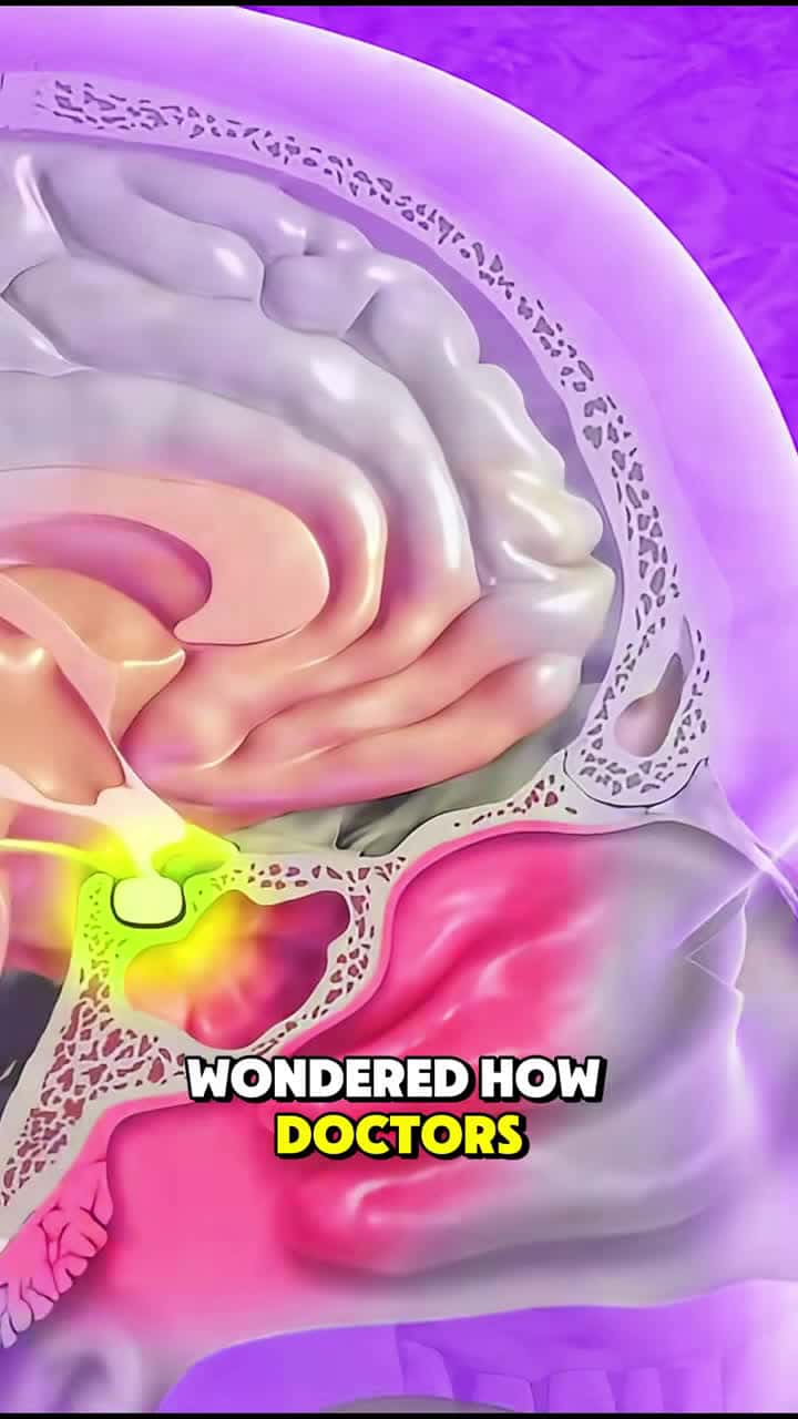Cover for They Went Through My Nose to Remove a Brain Tumor — Here’s How It Works. #TranssphenoidalSurgery #BrainSurgery #PituitaryTumor #EndoscopicSurgery #Neurosurgery #SkullBaseSurgery #ModernMedicine #MedicalTikTok #TikTokDoctor #LifeSavingSurgery #HealthTalk #HealingJourney #SurgeryExplained #ScienceInMedicine #wellnessrecovery