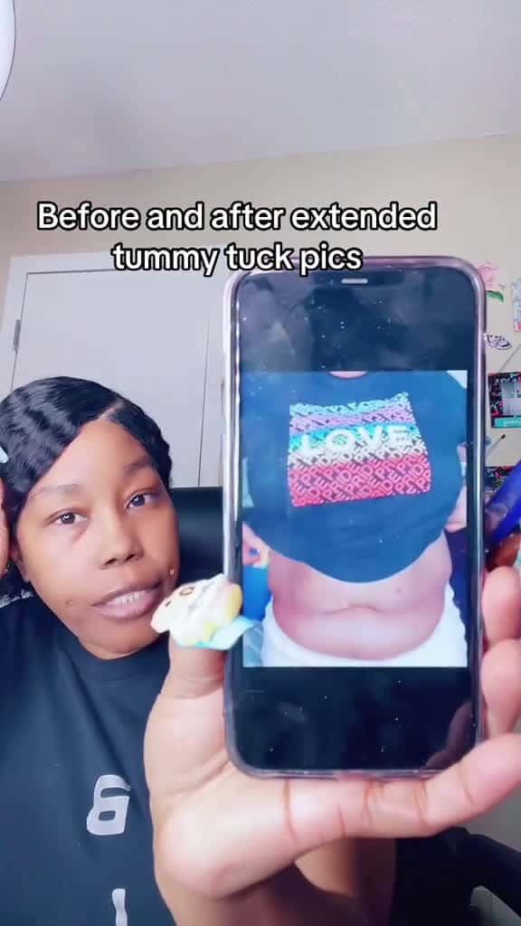 Cover for #tiktoklive #livehighlights before and after tummy tuck pics #tummytuck  created by Erinharri54 with Erinharri54’s original sound