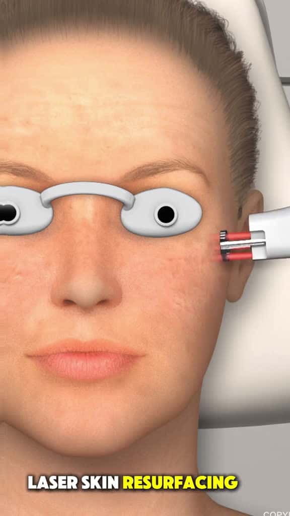 Cover for Lasik Skin Surgery 3D Animation skin lasik lasiksurgery skinsurgery laserskincare skinsurg 90015 #trendingscoopz