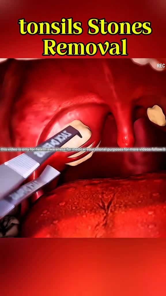 Cover for Bad Breath? It Might Be Tonsil Stones (How to Fix It!) #tonsilstones #oralhealth #entdoctor #badbreathfix #grossbutcool #DidYouKnow #medicaltips #healthyliving  created by 𝑰𝒎𝒎𝒆𝒓𝒔𝒊𝒗𝒆 𝑫𝒆𝒄𝒐𝒎 with 𝑰𝒎𝒎𝒆𝒓𝒔𝒊𝒗𝒆 𝑫𝒆𝒄𝒐𝒎’s original sound