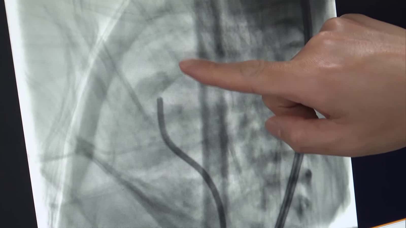 Cover for World’s First: Single Surgery Corrects Two Congenital Heart Defects in 1,300g “Palm-Sized” Baby in Shanghai