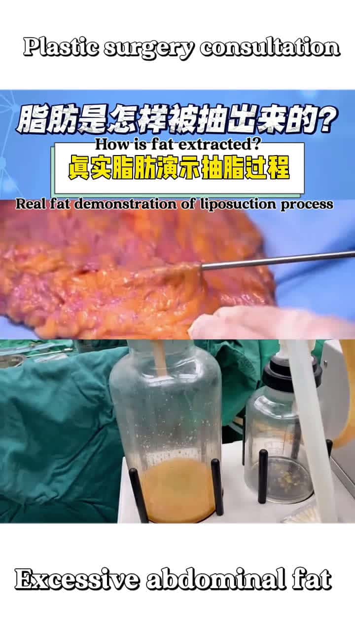 Cover for Revealing the secrets of liposuction #liposuction #cosmetic surgery