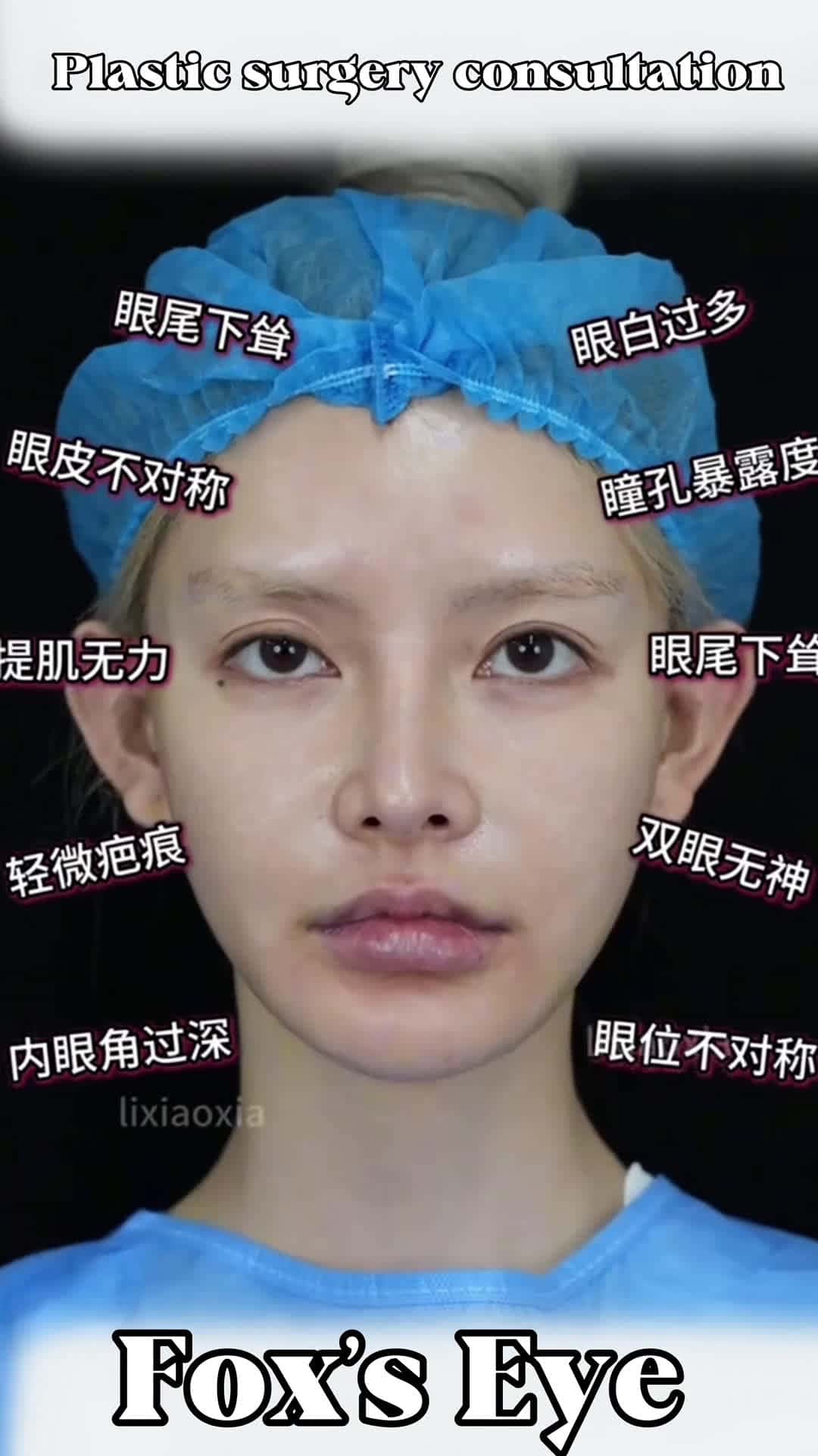 Cover for Does a fox eye look good? #cosmetic surgery #Fox's Eye #Eye synthesis