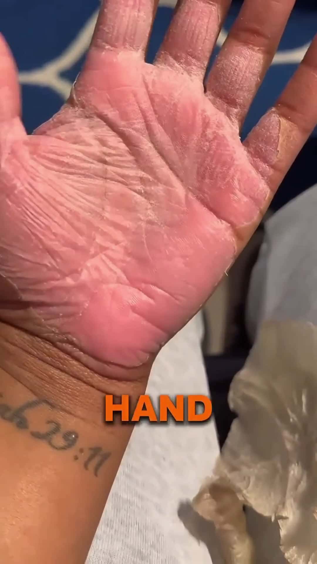 Cover for His Skin Fell Off!😱