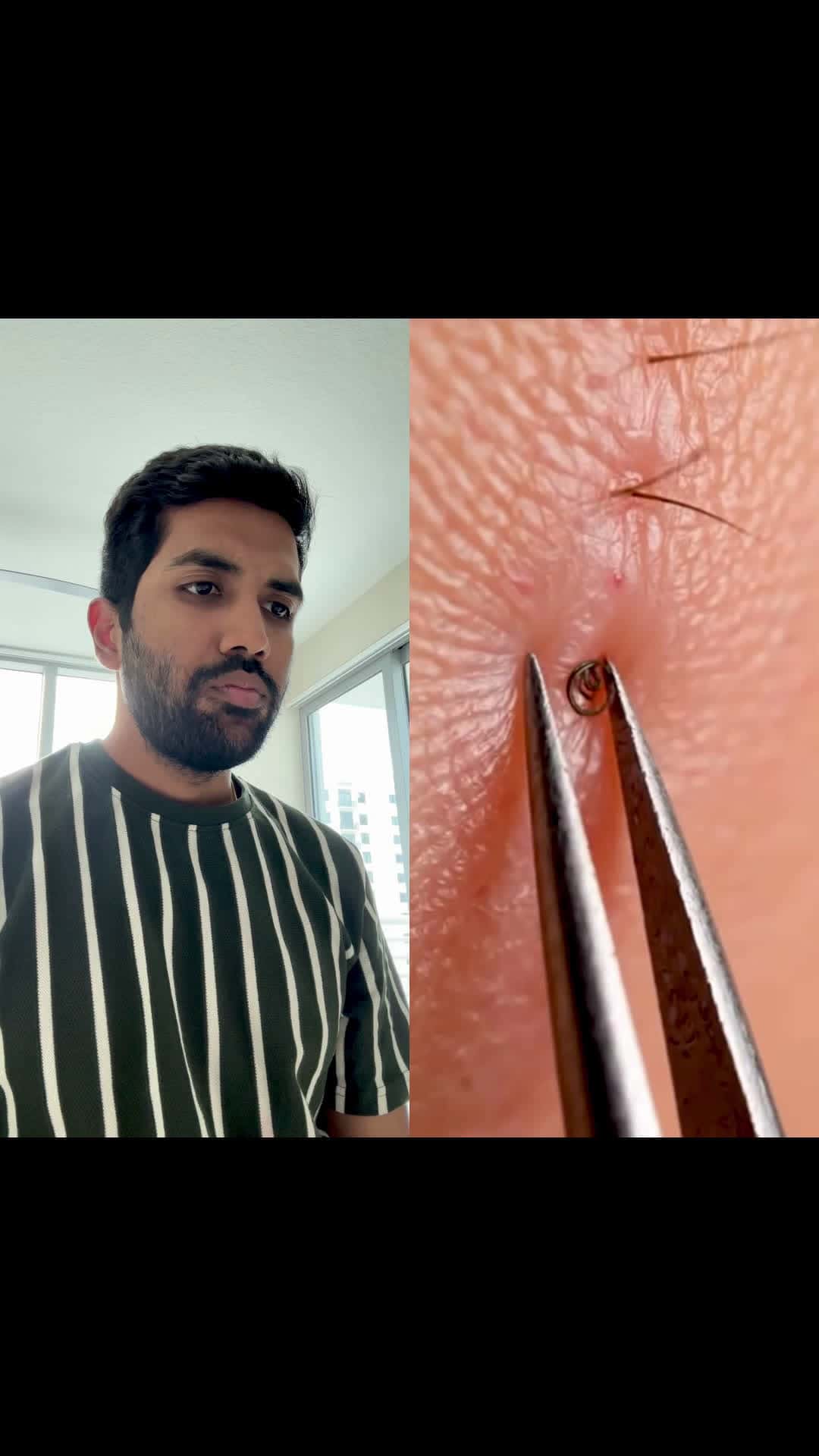 Cover for Ingrown hair