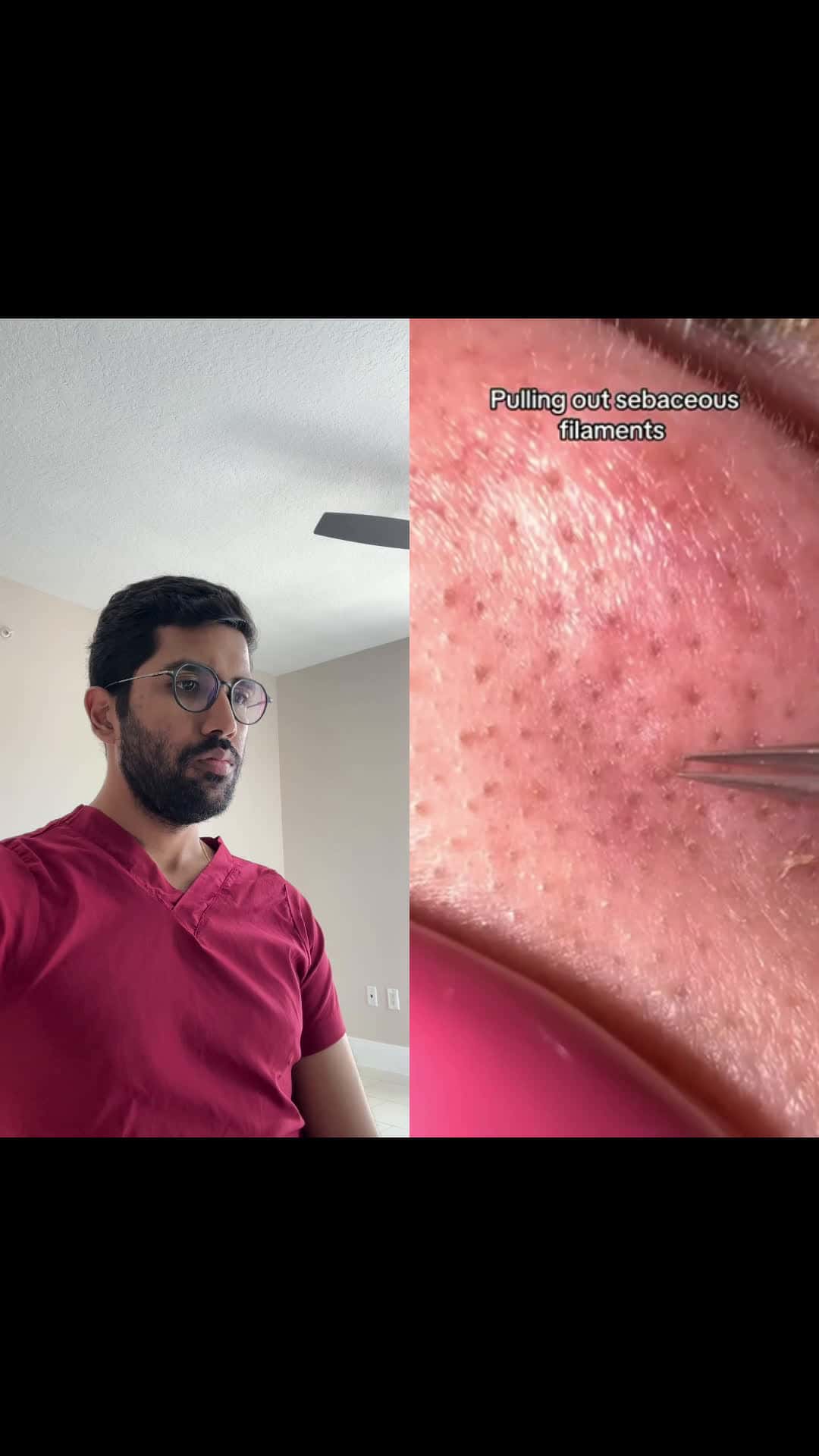Cover for Sebaceous filaments removal