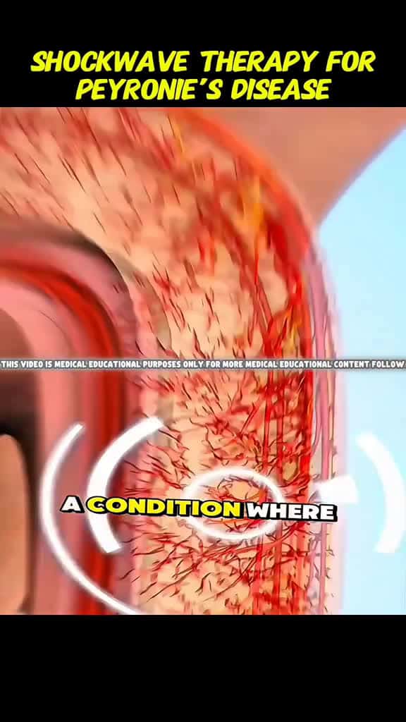 Cover for Shockwave Therapy for Peyronie's Disease (3D Animation)#shockwavetherapy #shockwave #therapy #peyronie #plaque #peyroniesdisease #skin #improve #blood #flow #anesthesia #patient #painless #safe #injections #disease #specialist ...