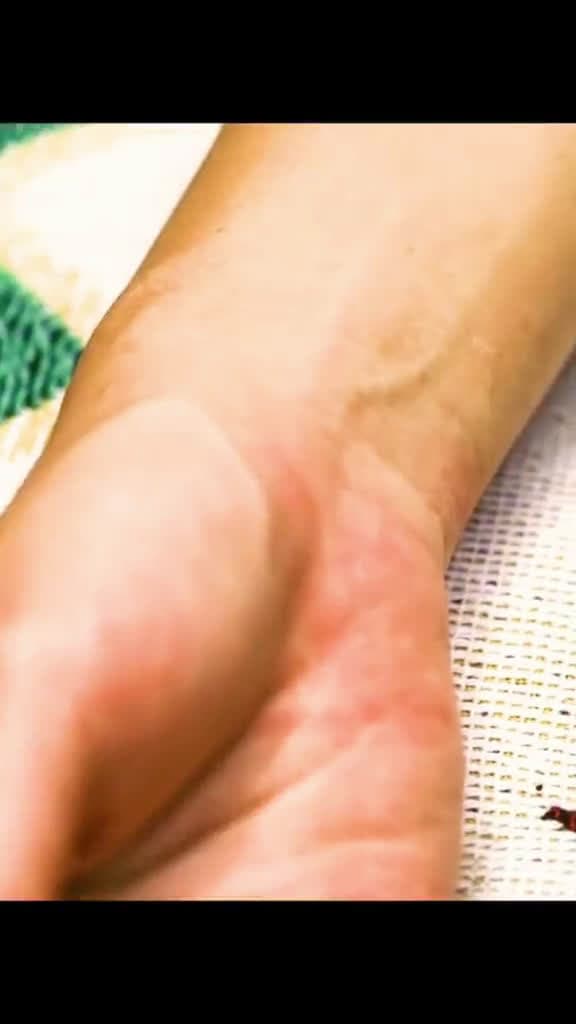 cover for Watch a mosquito in action up close as it draws blood from human skin 🦟 #Mosquito #Science