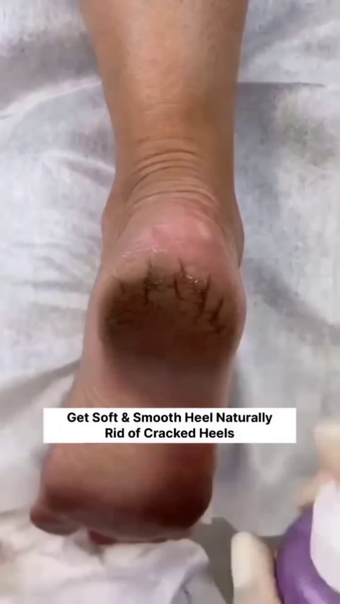 cover for crack heel no problem