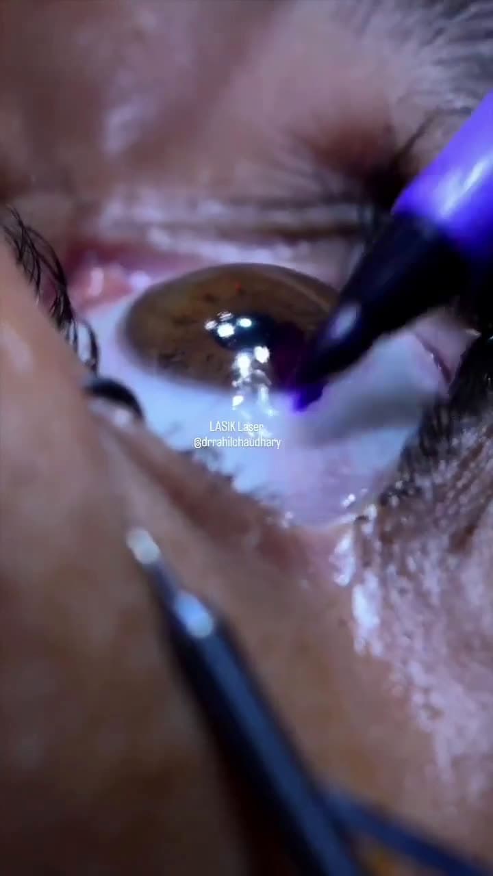 cover for Watch the intricate precision of LASIK surgery up close! 👁 #LASIK #SurgerySatisfaction #MedicalMarvel