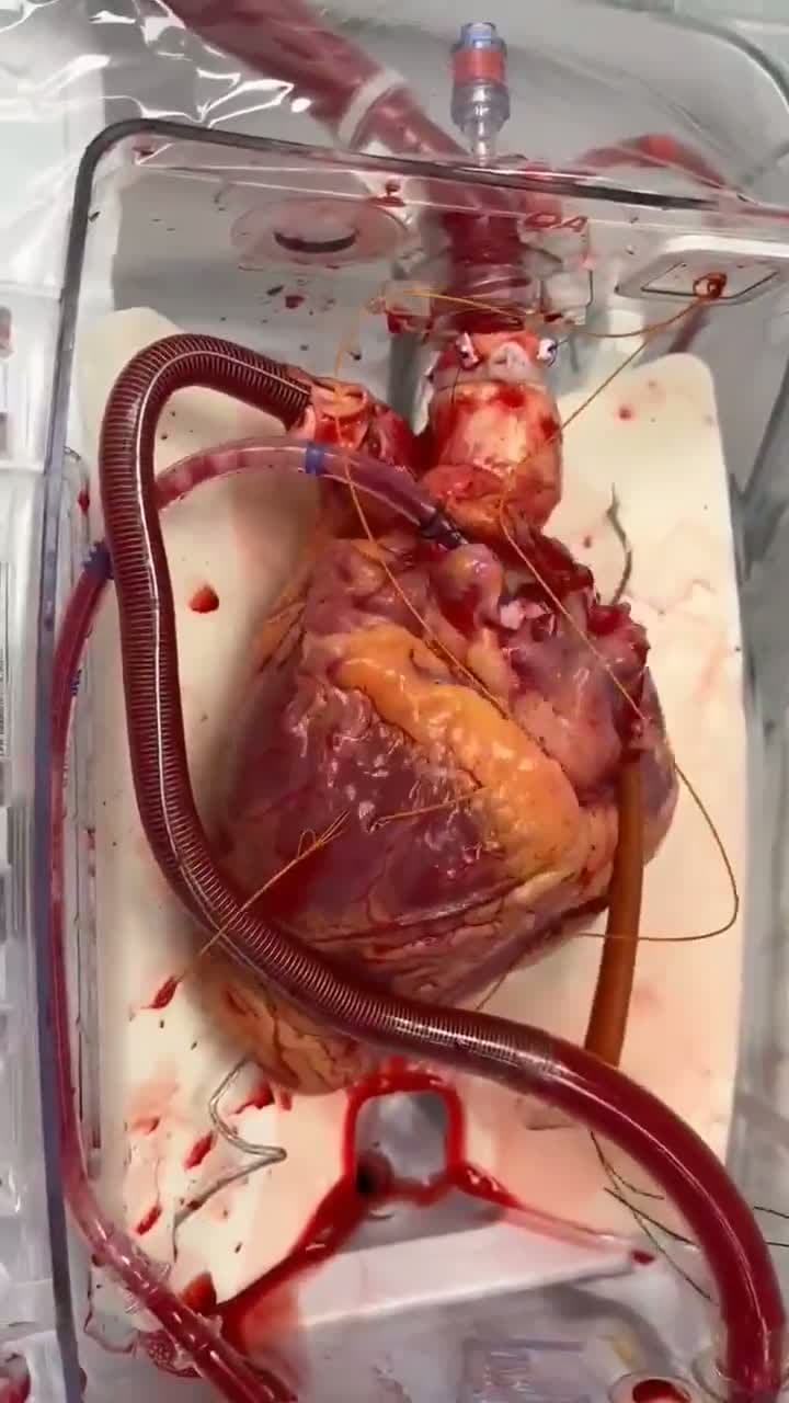 cover for Inside the journey of a heart waiting for a new home 💓🫀 #Transplant #MedicalMiracle #Lifesaving