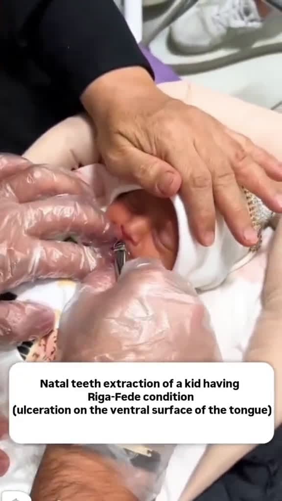 cover for Natal Tooth Extraction 😳👀 Why should we extract Natal teeth? • •  • 📽By@zahrabaghdar75  --------------------------------------- #dentistry #dental #dentist #dentists #dentalstudent #dentalhygienist #dentalart #doctor #doctors #...