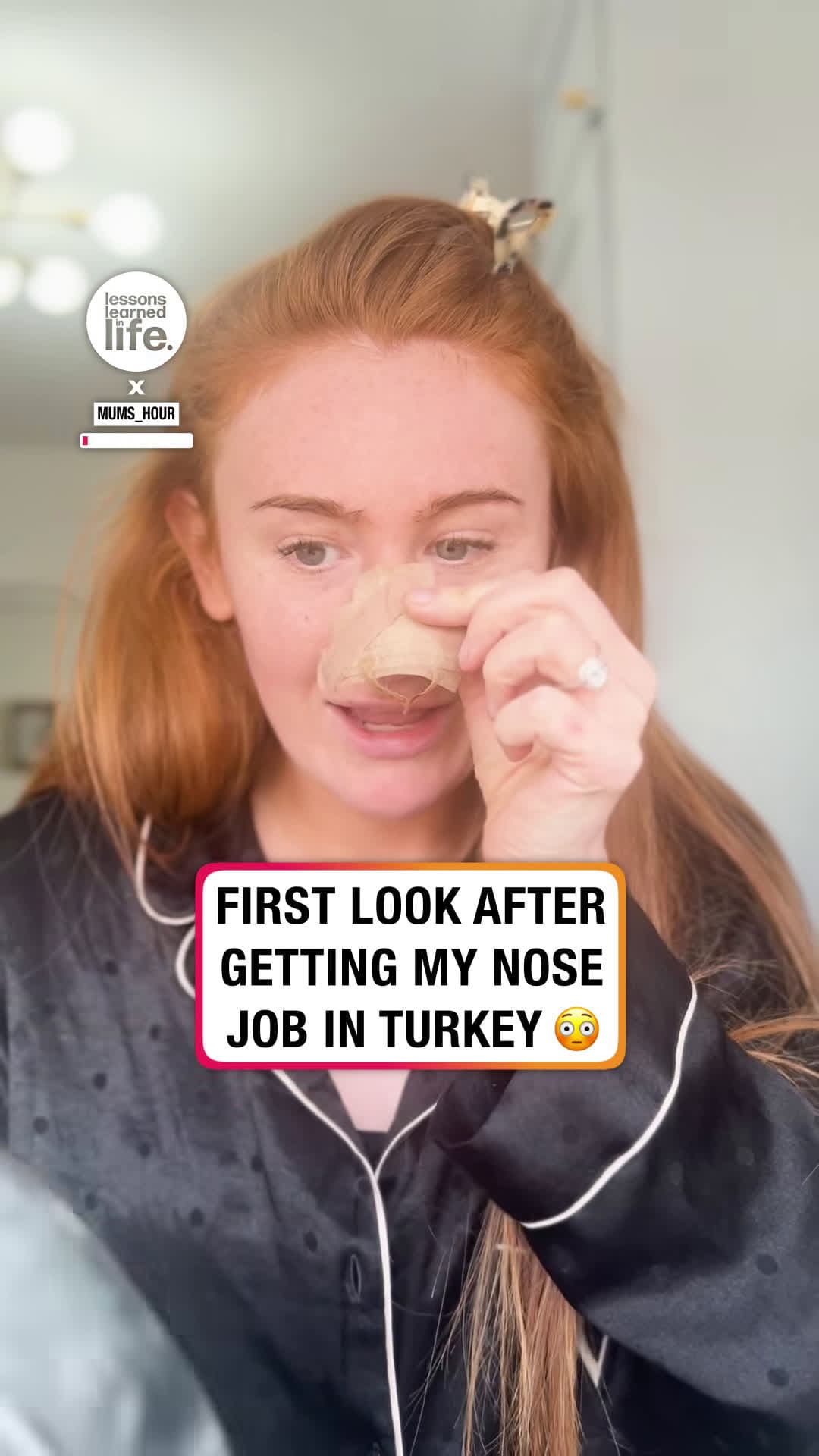 cover for #TooFunnyToScroll I felt so overwhelmed mums_hour #nose #nosejob #nosesurgery.