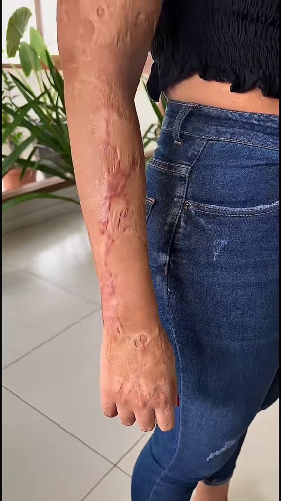 cover for Stunning scar cover-up with a gorgeous floral sleeve 🌹✨ #CoverUpTattoo #RoseTattoo #FloralTattoo