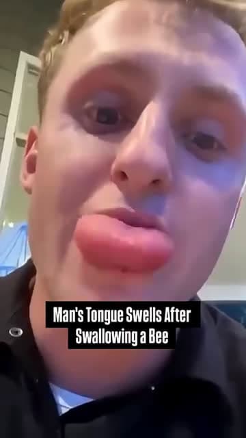 cover for Man's Tongue Balloons After He Swallows