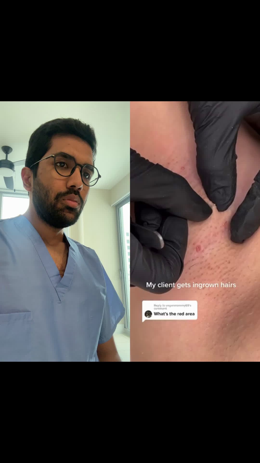 cover for Ingrown hair removal